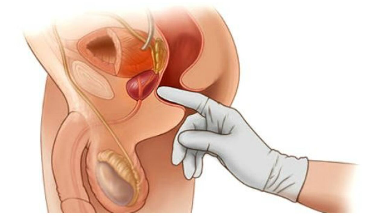 masaxe de próstata para a prostatite crónica