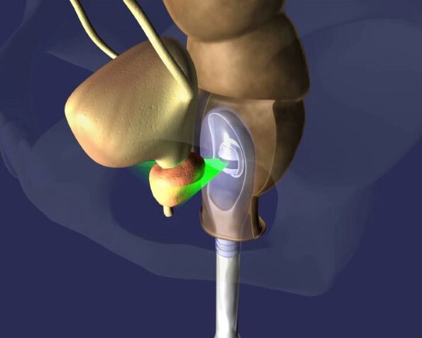 o impacto dos ultrasóns na próstata con prostatite