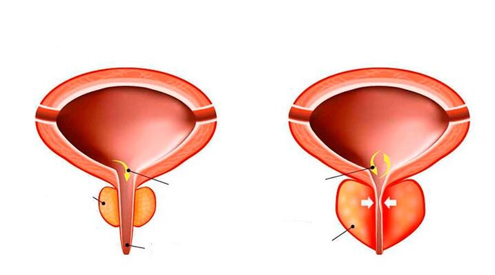 próstata normal e inflamada