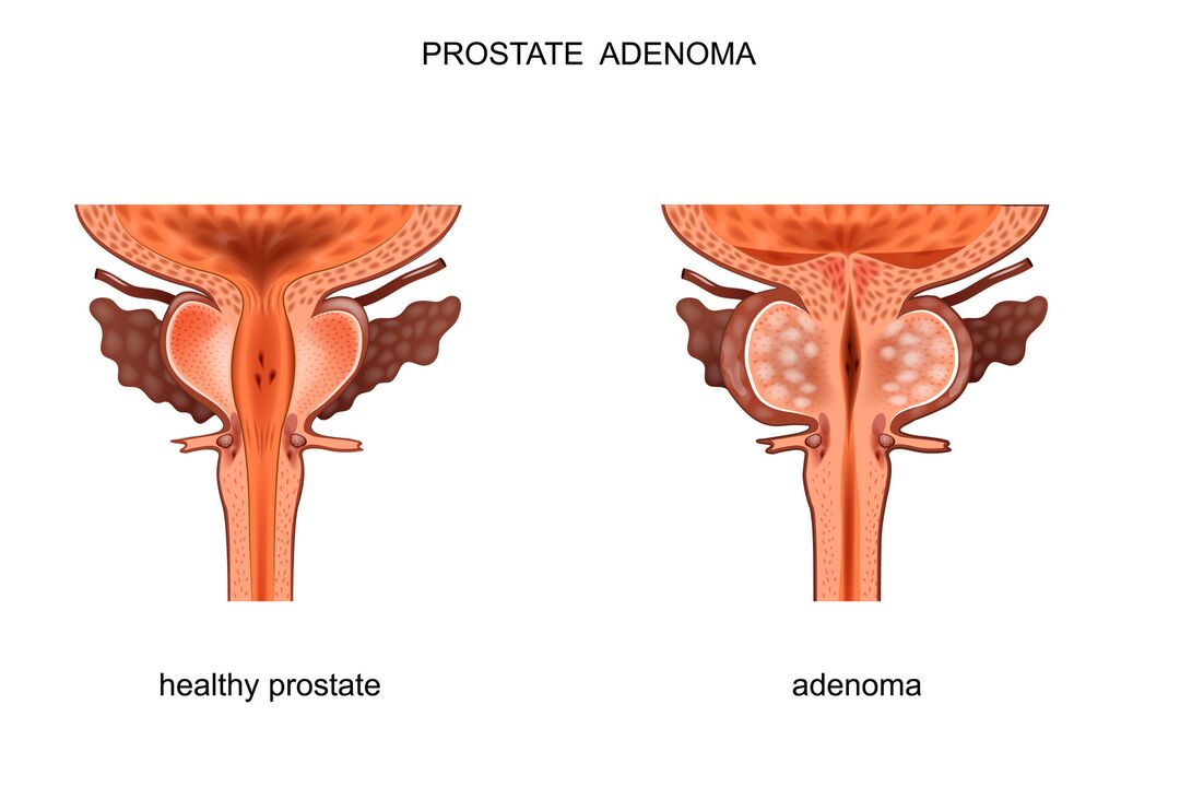 próstata sa e con adenoma